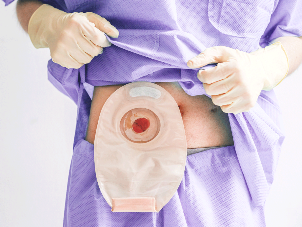 COLON CANCER AND WHY YOU MAY NEED A STOMA