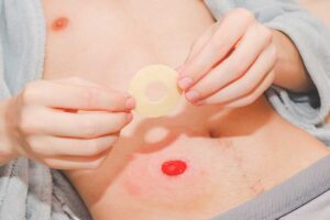 Risks of Using the Wrong Pouching System for Stoma Patients
